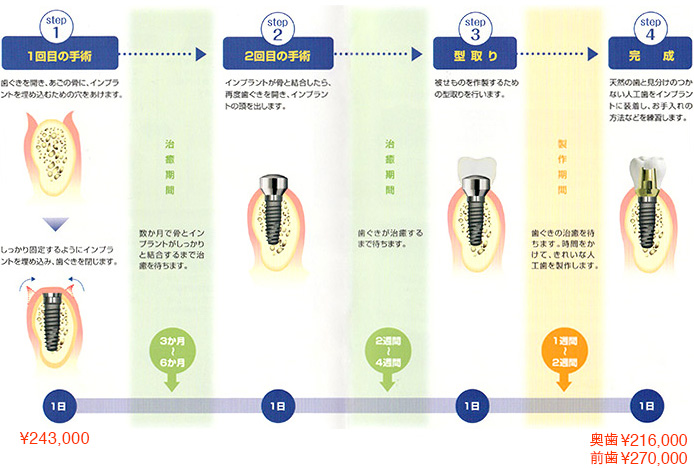 インプラント治療手順と料金